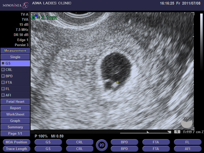 胎嚢像と胎児像(妊娠５週)