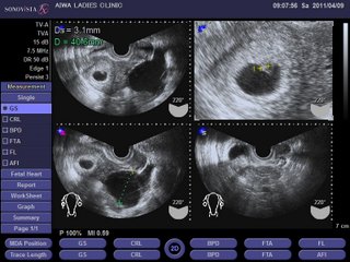 右卵巣嚢腫(妊娠5週)